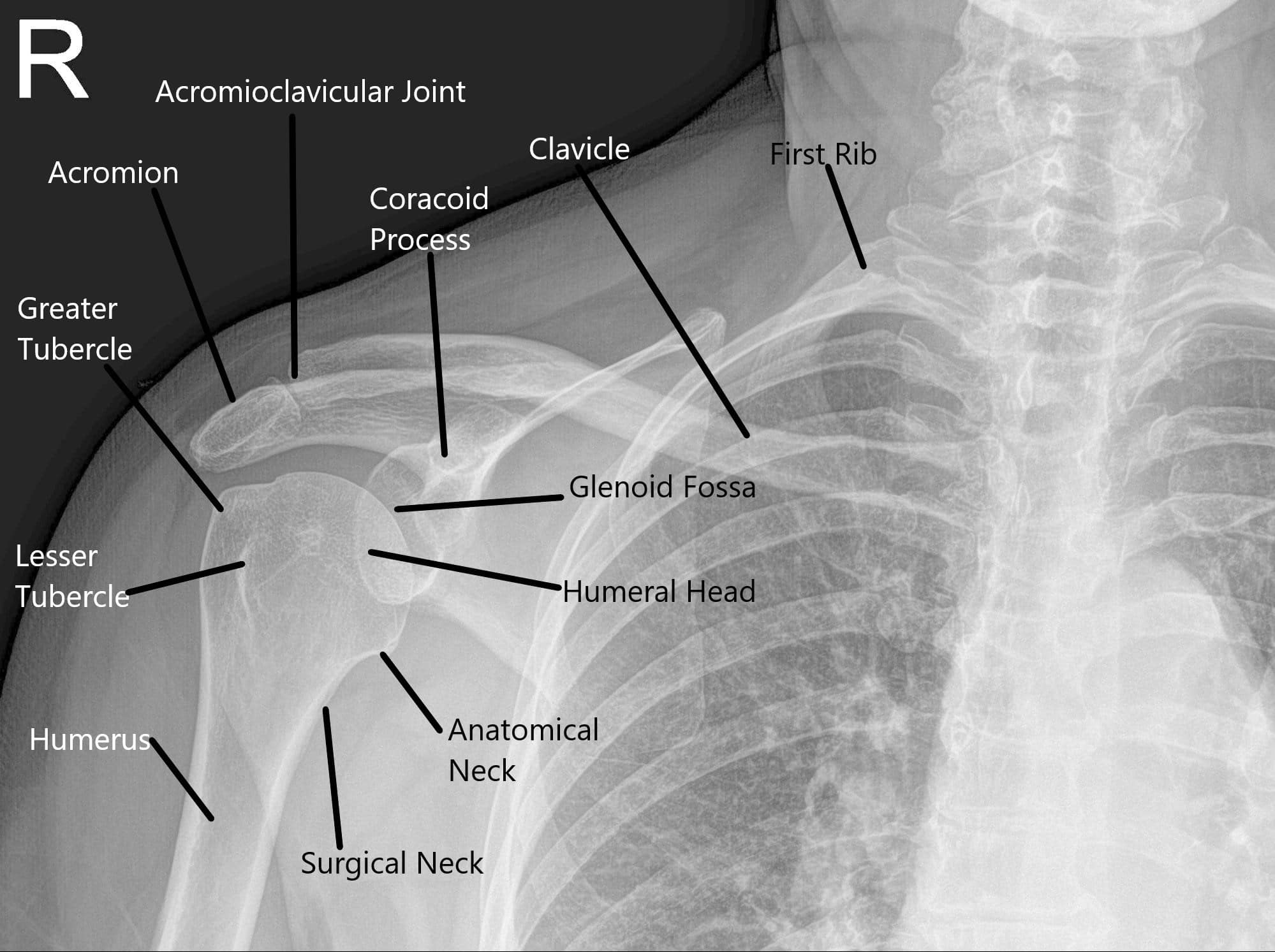 Shoulder Joint X Ray