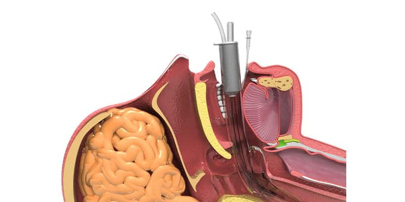 Laryngeal Mask Airway Insertion