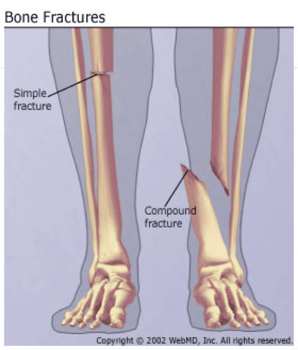 Complete bone fracture - denisseries