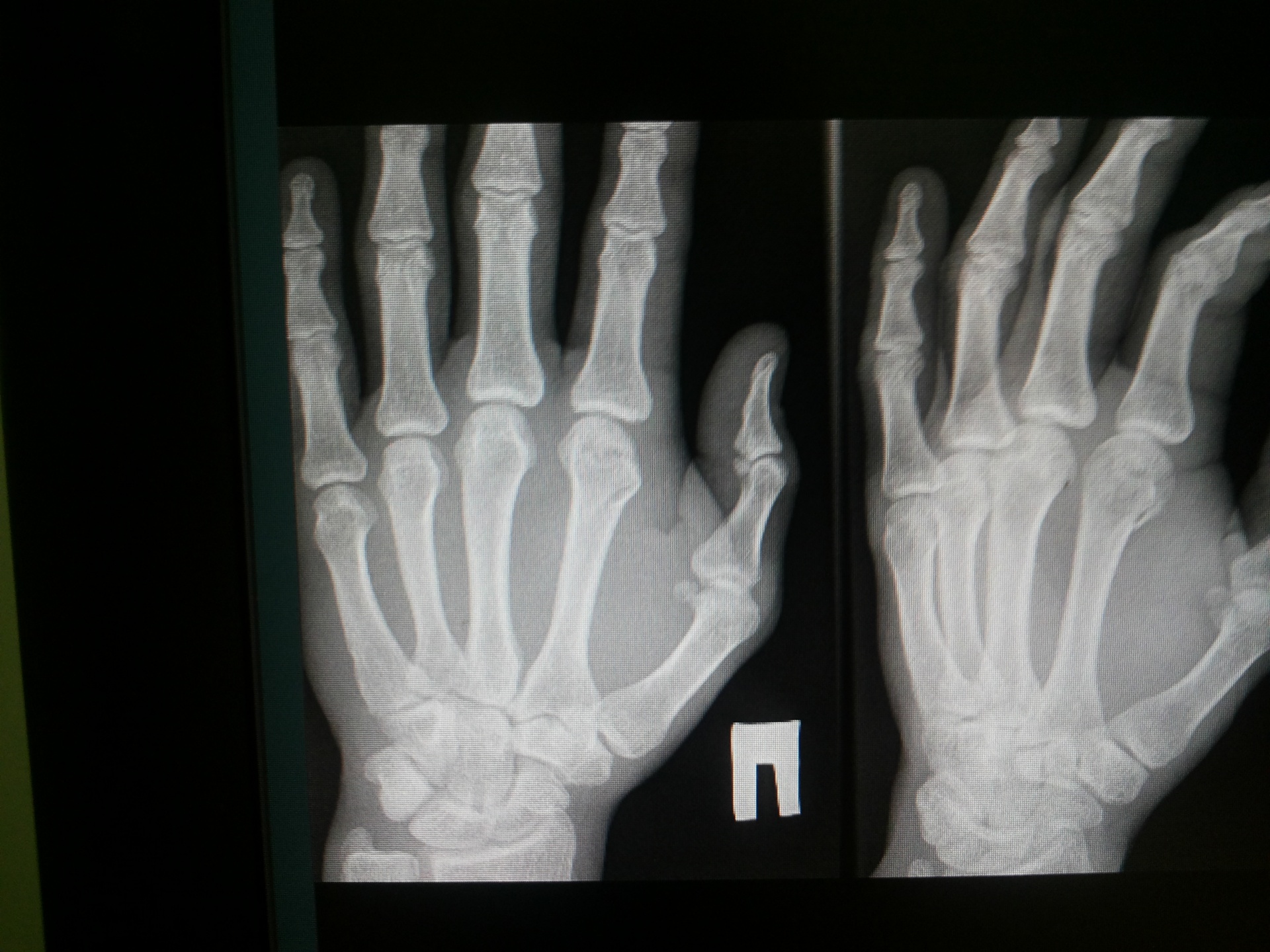 What Does Two Fingers Touching Mean - Ray Broken Sprained Xray Hand ...