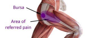 Bursitis Hip Pain Location Chart