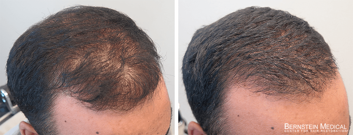 Minoxidil Before And After Men