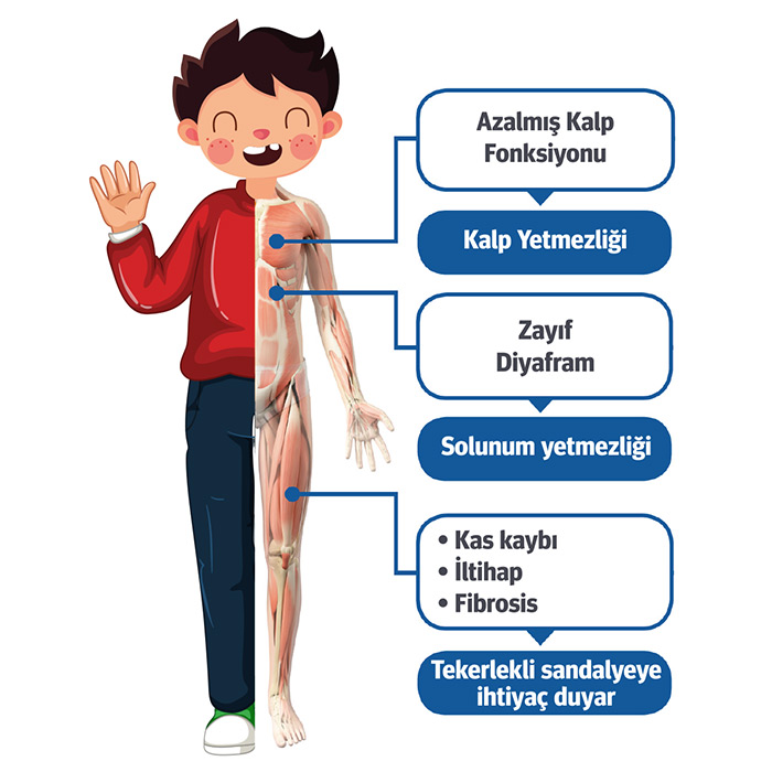 DMD Nedir