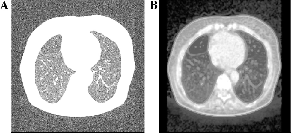 Figure 9: Analysis of Visual Quality of Restored Medical Image 2 (Gaussian Noise in σ = 50%).
(A) Noisy image, (B) restored image.