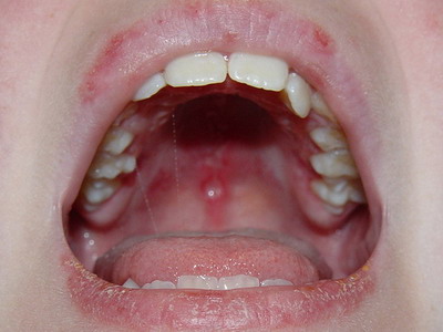 Nasal Ulcers Lupus