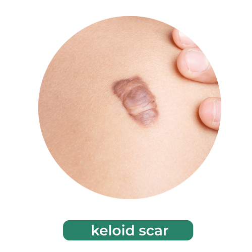 bekas luka keloid