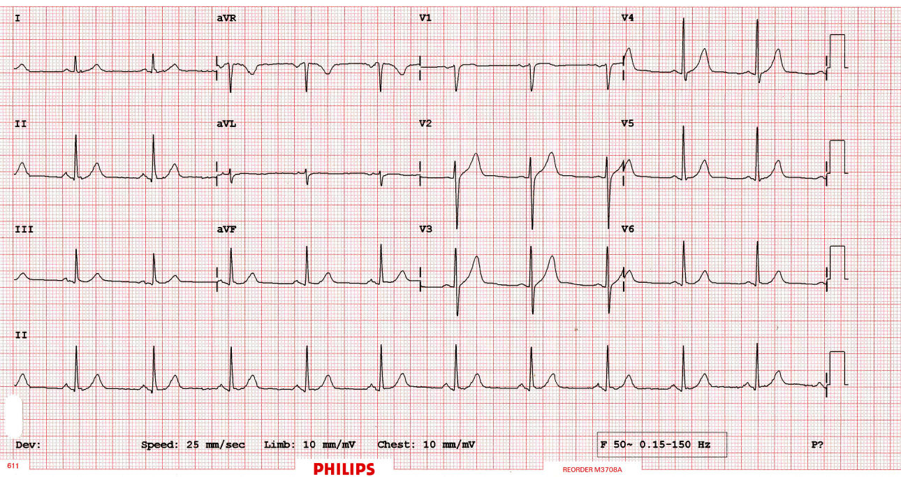 Normal ECG Graph