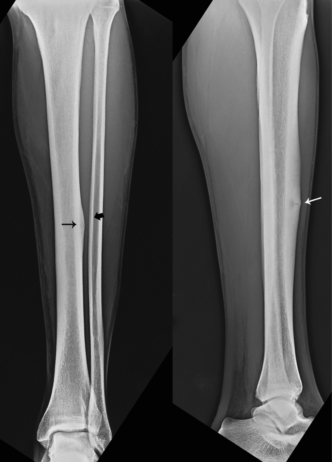 [DIAGRAM] Diagram Of Tibia Stress Fracture - MYDIAGRAM.ONLINE