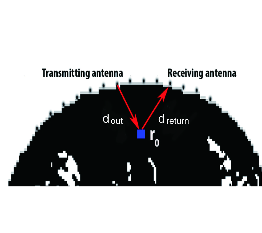 PERFORMANCE AND ROBUSTNESS OF A MULTISTATIC MIST BEAMFORMING ALGORITHM FOR BREAST CANCER DETECTION