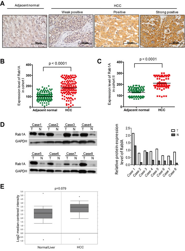 Rab1A is overexpressed in HCC, which is associated with a poor prognosis.