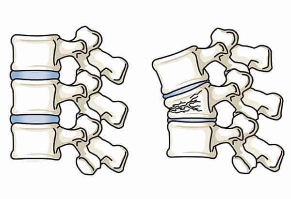 Compression Fracture Diagram