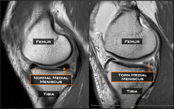 Medial Meniscus Tear Mri