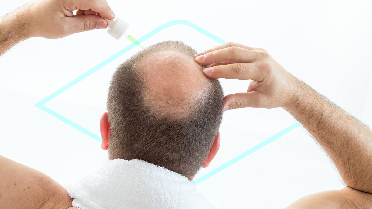 El Minoxidil es el medicamento de moda para evitar la caída del pelo ...