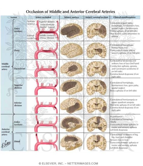 Anterior Cerebral Artery Stroke