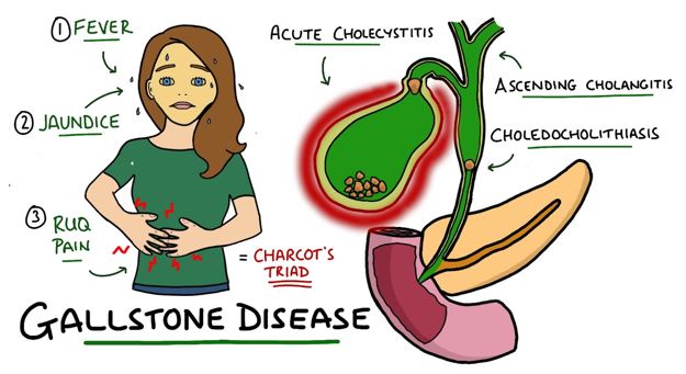 HRT and Gallbladder Stones