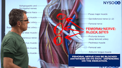 Knee Nerve Block Procedure