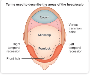 hair transplant donor area: crown transplantation