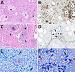 Microscopic mammary lesions of an index case in US dairy cattle naturally infected with highly pathogenic avian influenza A(H5N1) virus clade 2.3.4.4b. A) Mammary gland alveoli show epithelial attenuation and vacuolation (arrows), leading to degeneration with intraluminal sloughing and neutrophilic intraluminal inflammation (asterisk). Hematoxylin and eosin stain. B) Mammary glad alveoli show degenerative epithelial cells (asterisks) and strong intracytoplasmic and nuclear immunoreactivity to influenza A virus nucleoprotein. C) Cuboidal epithelium lining of the interlobular duct was markedly attenuated (arrowheads) with abundant intraluminal sloughing and neutrophilic inflammation (asterisk). Hematoxylin and eosin stain. D) Interlobular duct shows of attenuating and degenerative epithelium by intranuclear and cytoplasmic immunoreactivity (brown labeling) with immunopositive intraluminal debris and inflammation (asterisk). Scale bars indicate 200 μm. E, F) Modified Wright's stained representative cytology images of milk from a dairy cow with highly pathogenic avian influenza A(H5N1) virus infection, demonstrating moderate to marked neutrophilic inflammation (red arrows) with low numbers of vacuolated macrophages (black arrows) among large numbers of lipid vacuoles. A 100-cell count was performed, and nucleated cells were found to consist of 83% neutrophils, 12% macrophages, and 5% lymphocytes. Original magnifications ×500 for panel E and ×1,000 for panel F. 