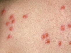 Rashes: The Itchy Truth - KidsHealth