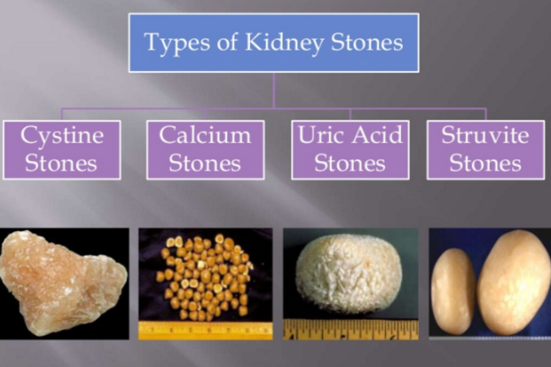 Uric Acid Kidney Stone