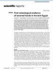 Research paper thumbnail of First osteological evidence of severed hands in Ancient Egypt