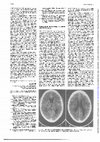 Research paper thumbnail of Subarachnoid haemorrhage associated with MDMA abuse