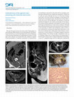 Endometrioma of the sigmoid colon presenting with intestinal obstruction Cover Page