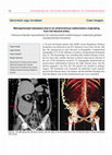 Research paper thumbnail of Retroperitoneal hematoma due to an arteriovenous malformation originating from the femoral artery