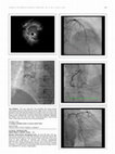 Transitioning Emergency Atrial Fibrillation Management (Team) Model Improves Quality of Life and Helps Patients Avoid Ed Visits Cover Page