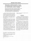 Research paper thumbnail of Takotsubo-cardiomyopathy: A case of extremely fast recovery described by multimodality cardiac imaging