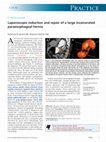 Research paper thumbnail of Laparoscopic reduction and repair of a large incarcerated paraesophageal hernia