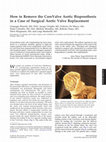 Research paper thumbnail of How to Remove the CoreValve Aortic Bioprosthesis in a Case of Surgical Aortic Valve Replacement