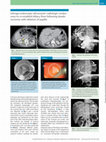 Research paper thumbnail of Salvage endoscopic ultrasound-radiologic rendezvous to re-establish biliary flow following duodenectomy with ablation of papilla