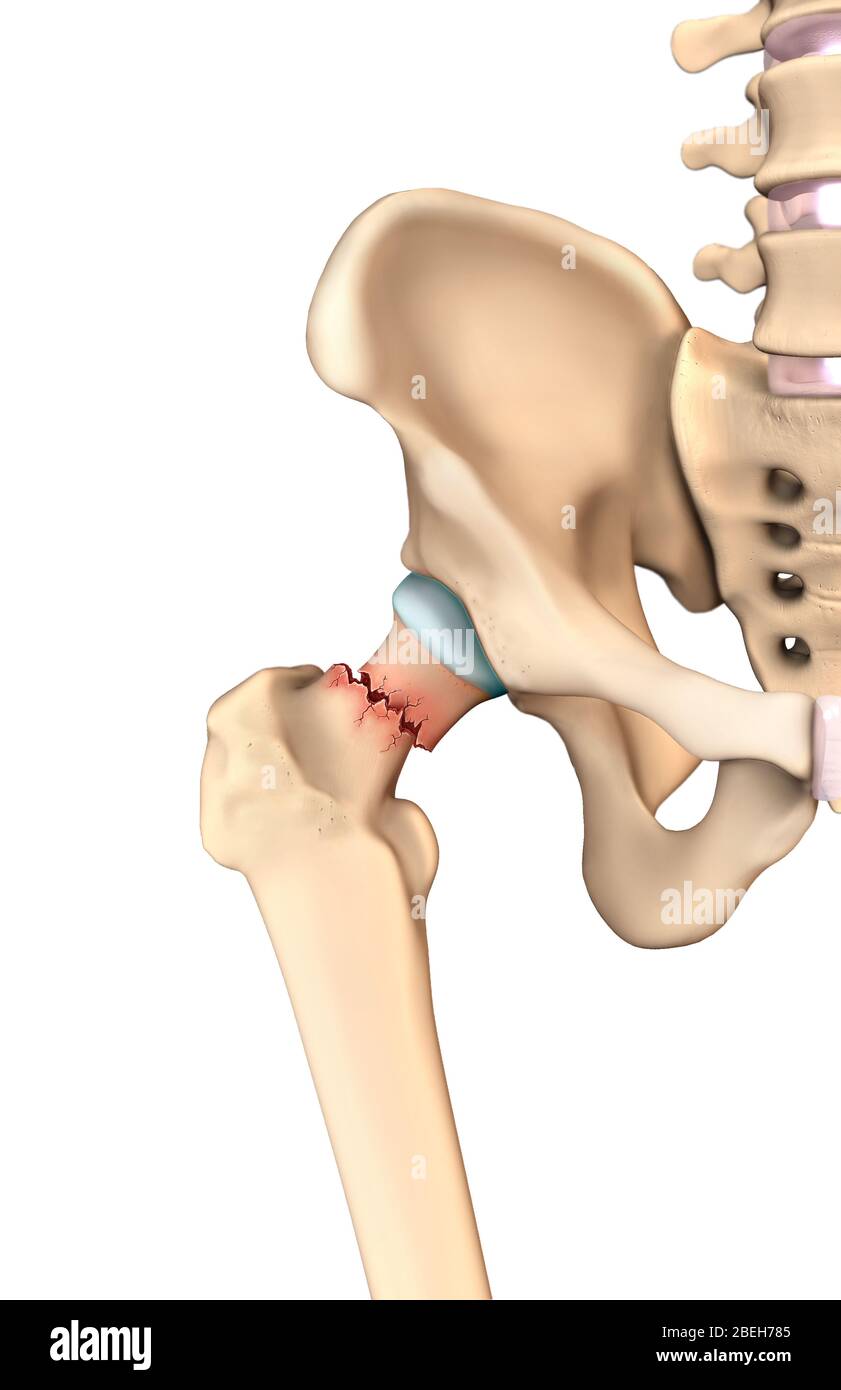 Hip Fracture, Illustration Stock Photo