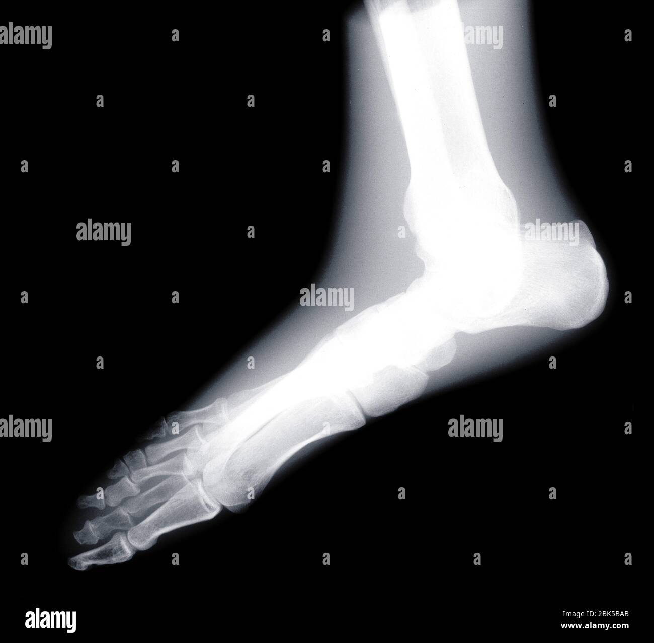 Human foot, X-ray. Stock Photo