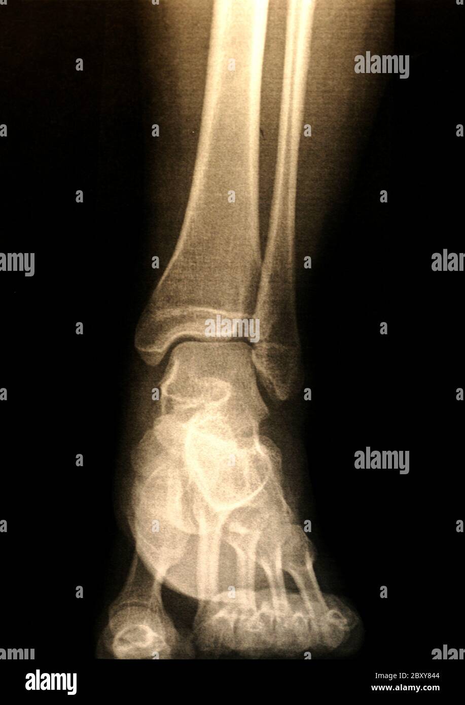 A X-ray of a foot Stock Photo