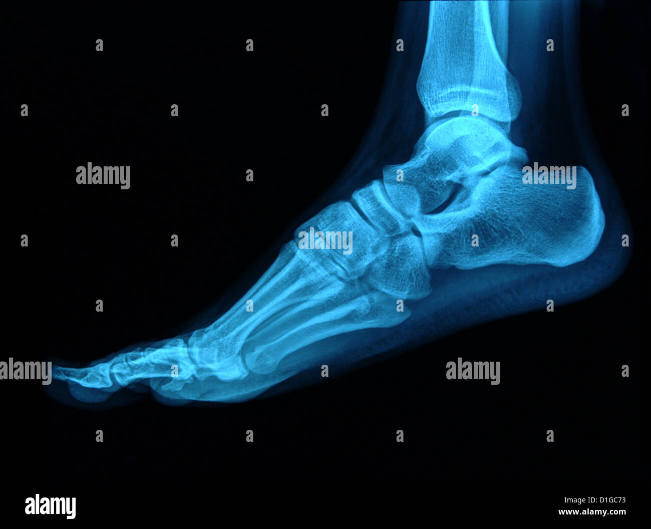 Foot xray Stock Photo