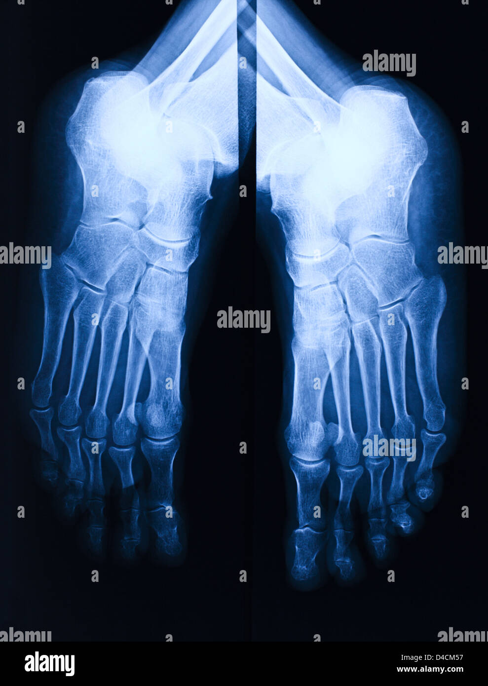 image of blue foot xray Stock Photo