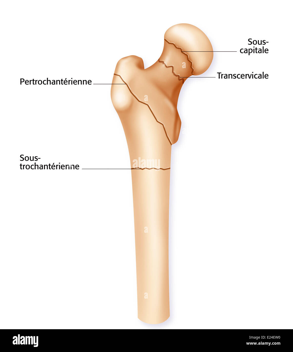 Fractured femur Stock Photo