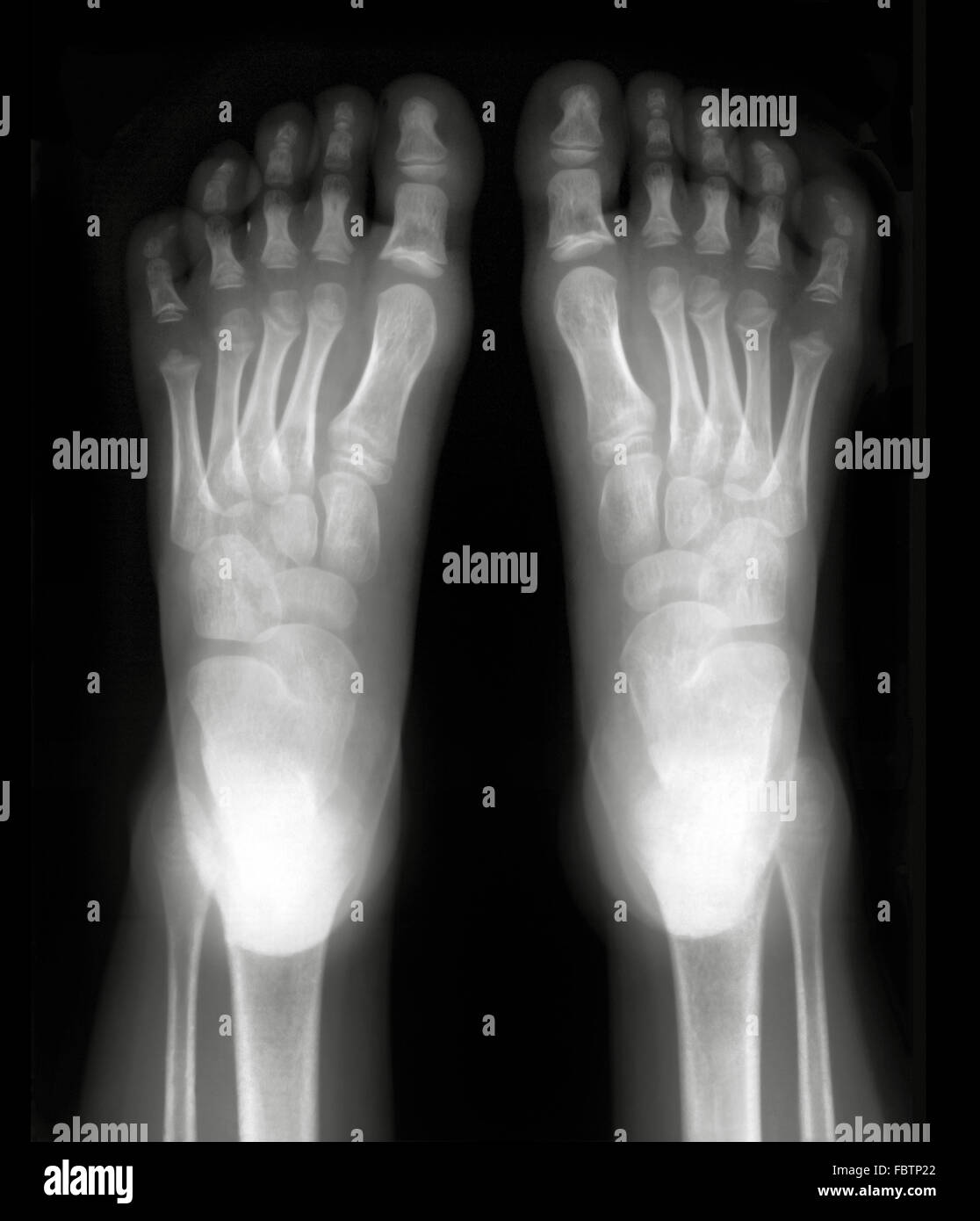 Foot xray Stock Photo