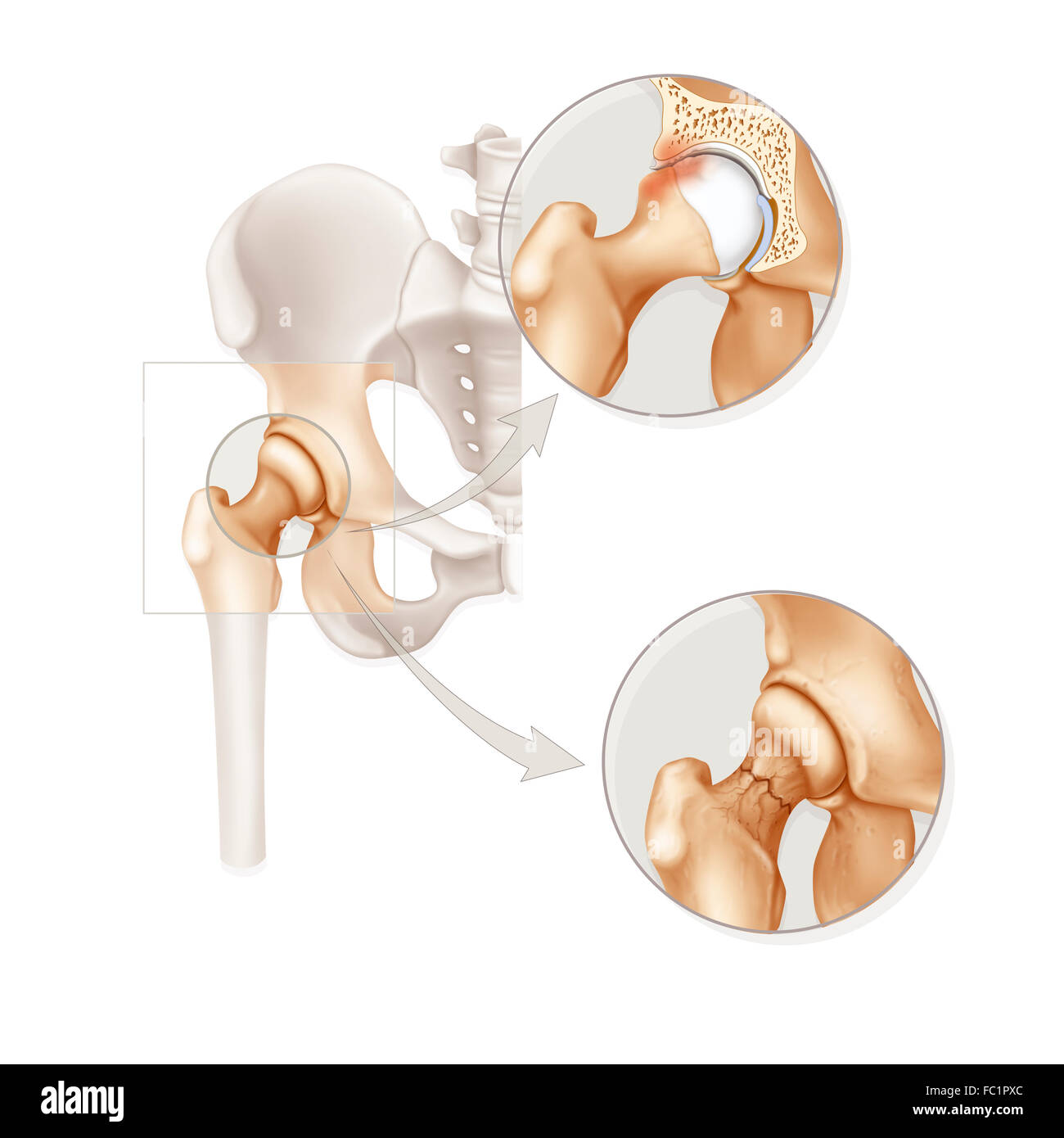 HIP PATHOLOGY Stock Photo