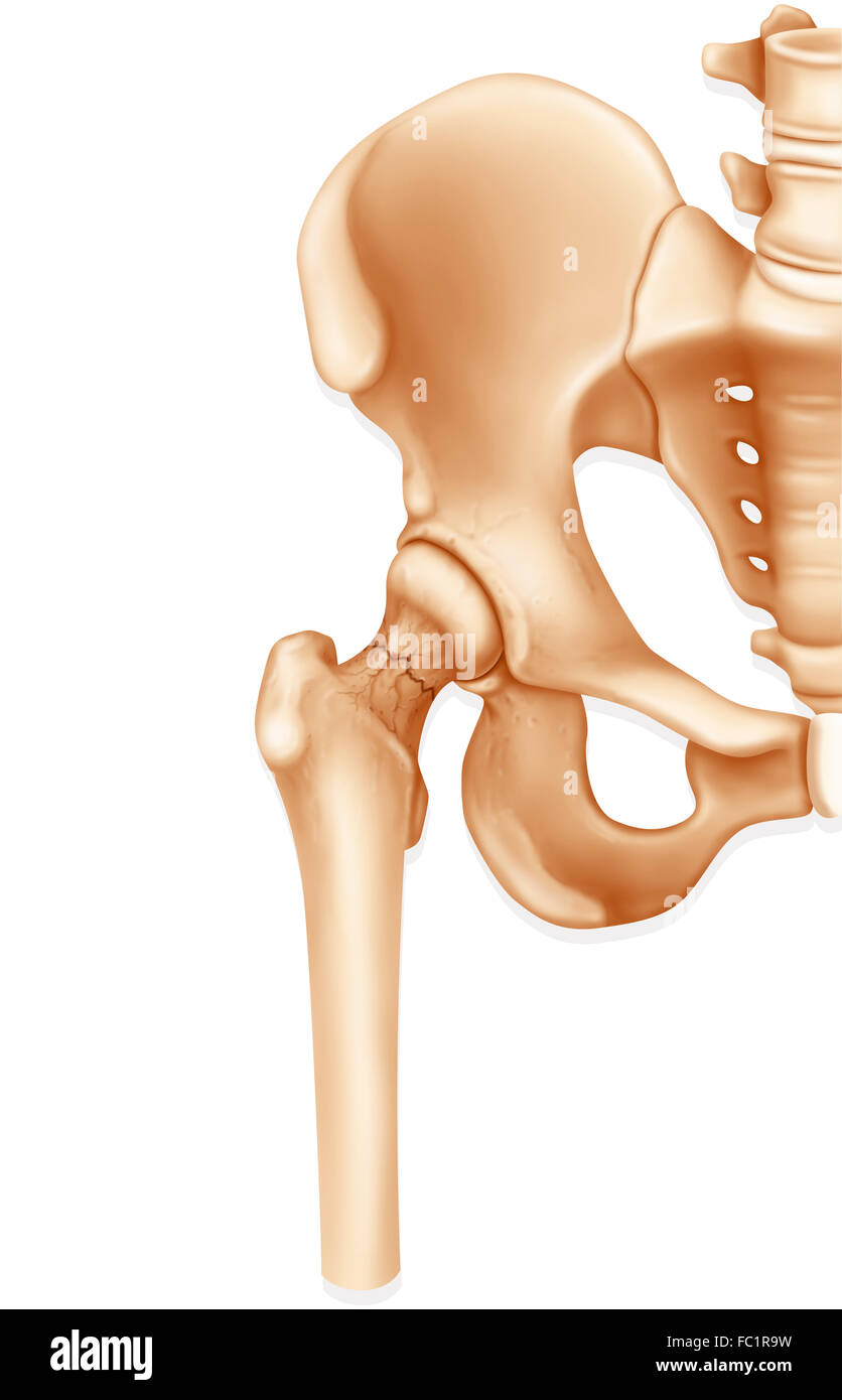 FRACTURED FEMUR Stock Photo