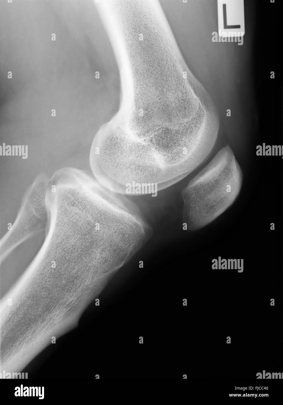 Xray Knee Stock Photo