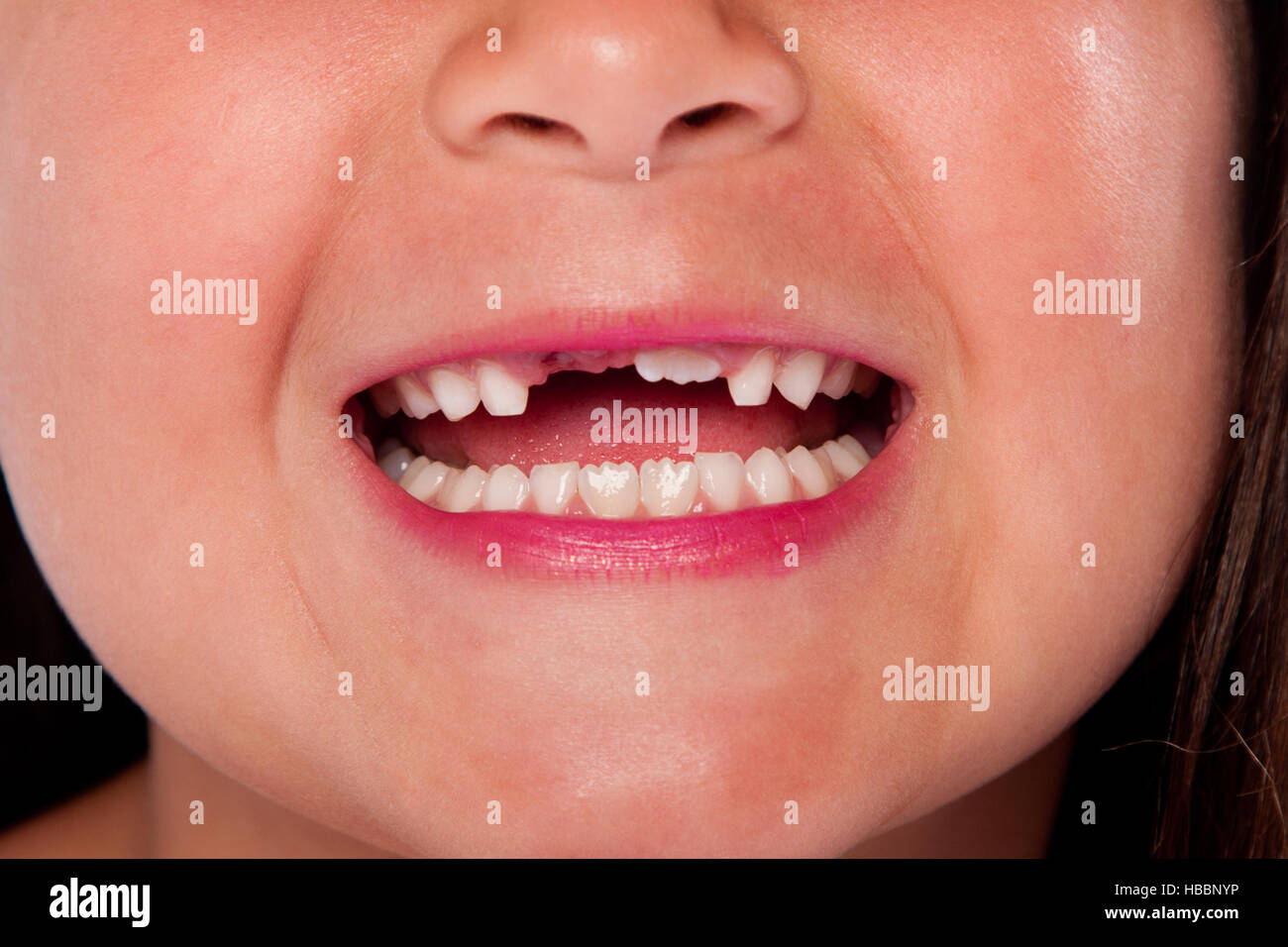 Missing teeth mouth Stock Photo