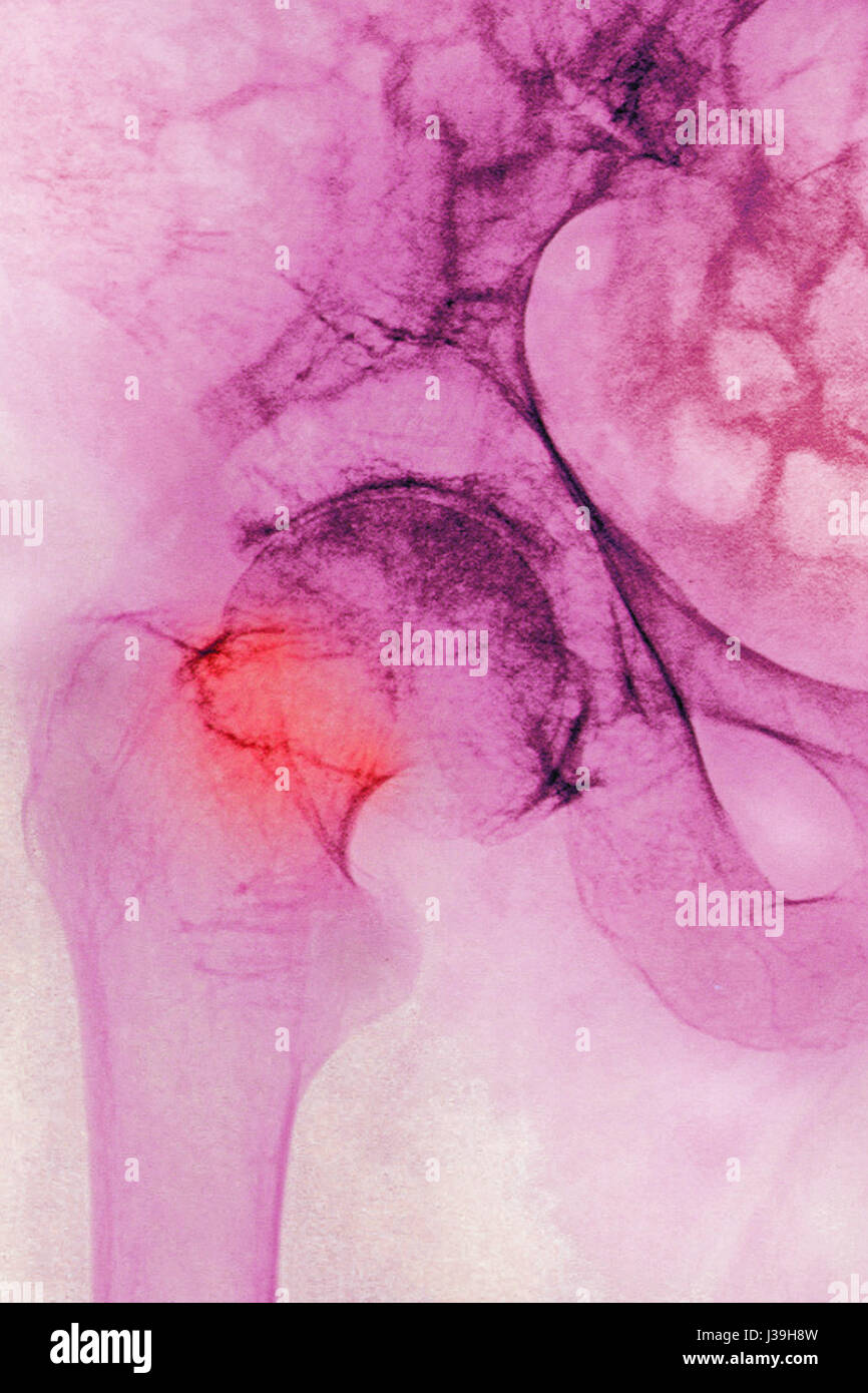 FRACTURED HIP, X-RAY Stock Photo