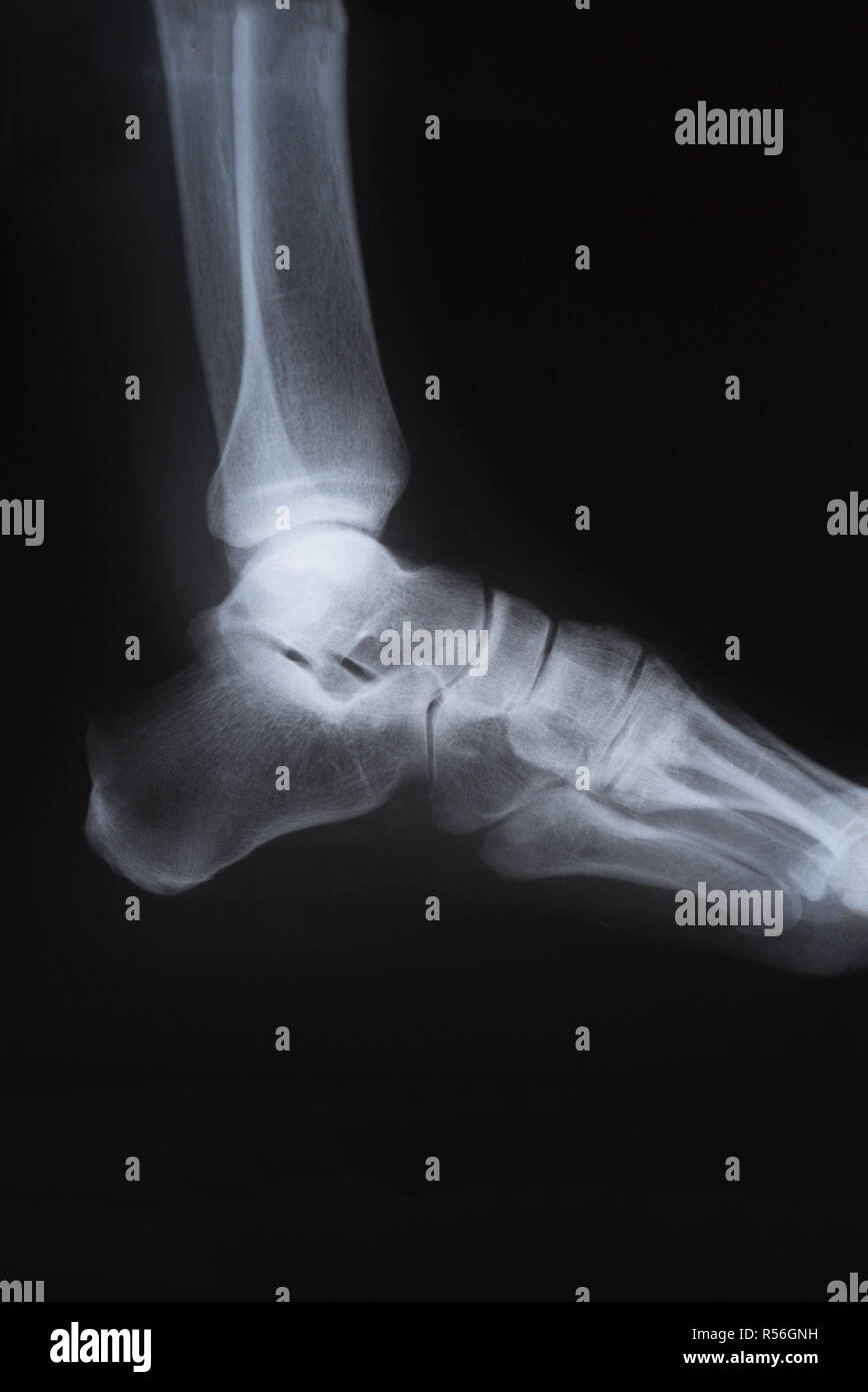 Medical X ray image of foot Stock Photo