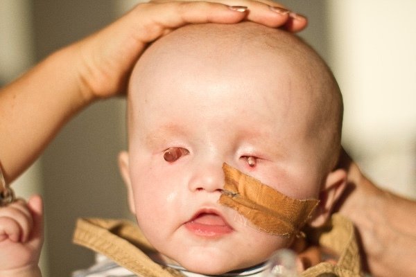 Baby born without eyes