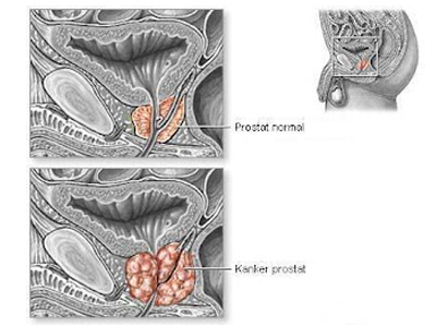 Detail Gambar Kanker Dubur Nomer 3