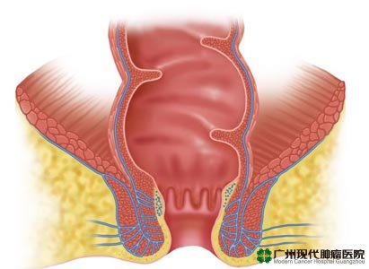 Detail Gambar Kanker Dubur Nomer 7