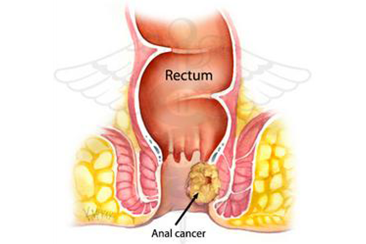 Detail Gambar Kanker Dubur Nomer 10